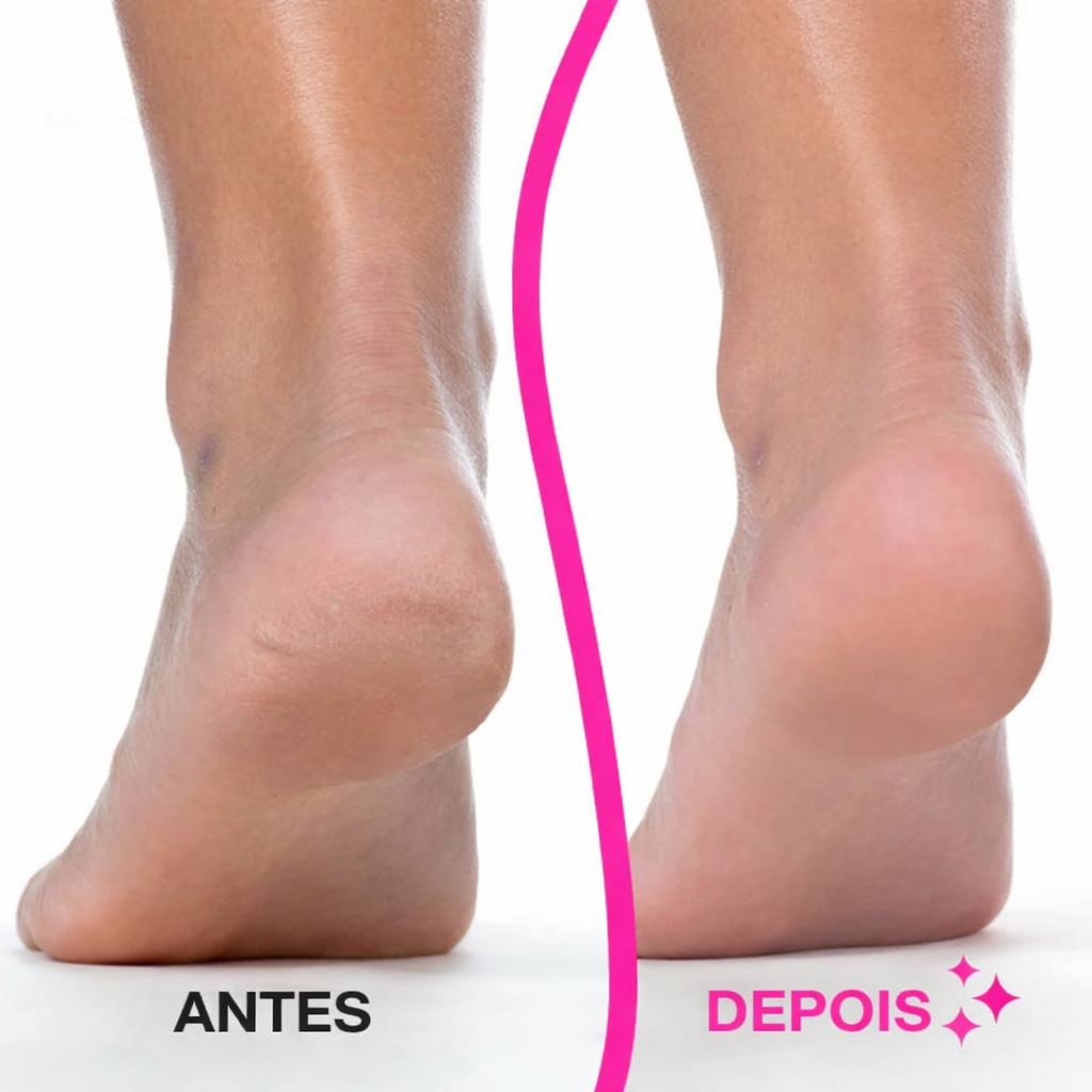 Removedor Elétrico de Calos para Pés – Pele Suave, Limpa e Renovada