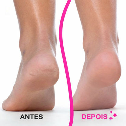 Removedor Elétrico de Calos para Pés – Pele Suave, Limpa e Renovada